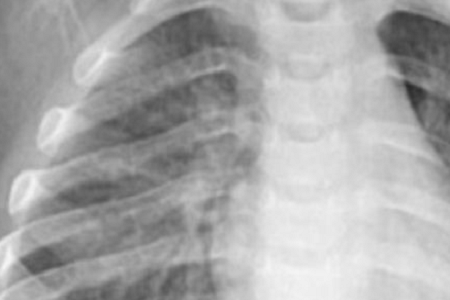 Detecção rápida de Chlamydia pneumoniae: confiável e eficiente